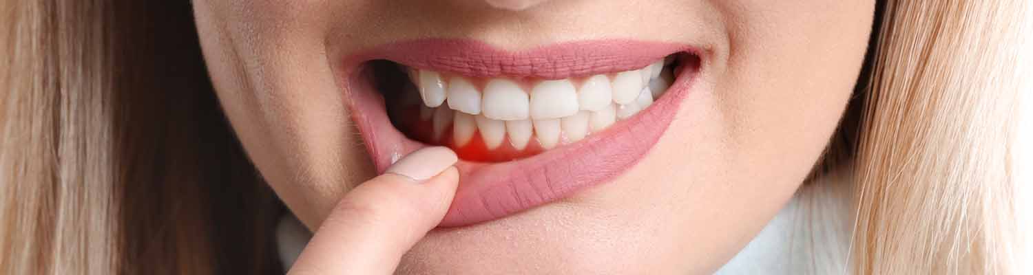 Tandkødsbetændelse - Gingivitis - Tandbehandling i Hillerød - www.tand3400.dk Tandkødsbetændelse - Gingivitis - Tandbehandling Hillerød - www.tand3400.dk